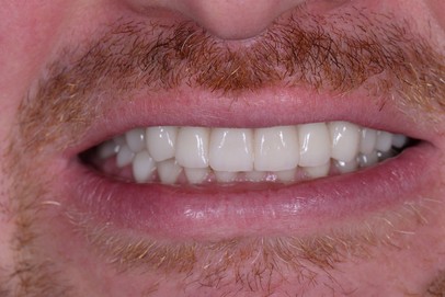 after dental implants