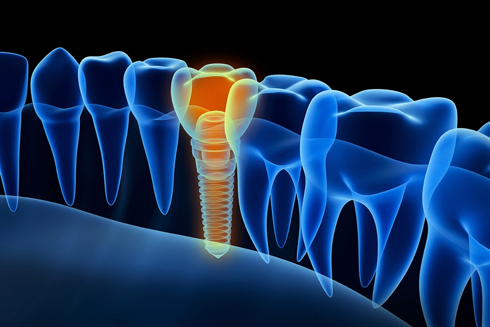 thermal view of tooth implant