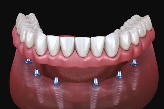 dental implants
