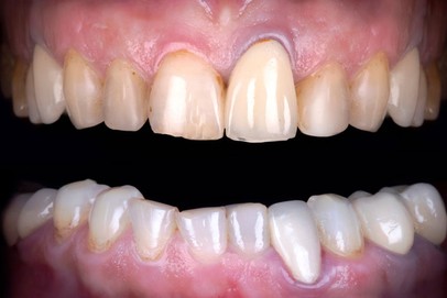 before porcelain veneers