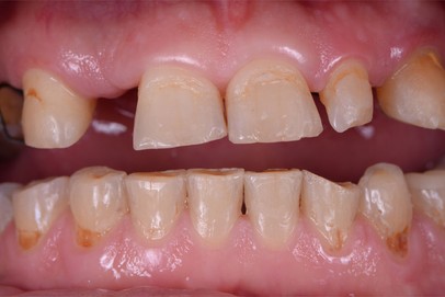 before dental implants