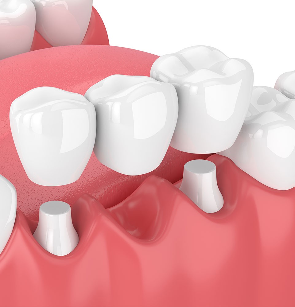 Dental bridge illustration