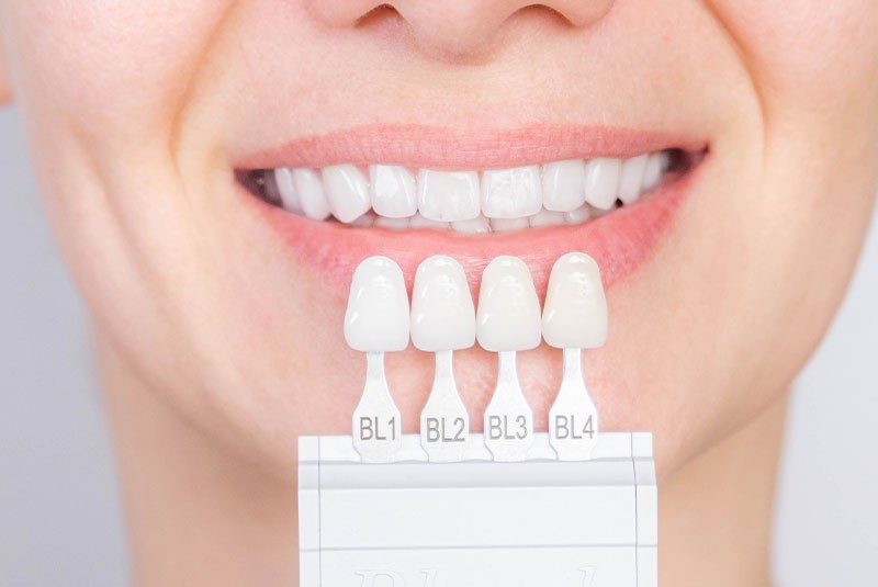 Porcelain veneers being placed on teeth