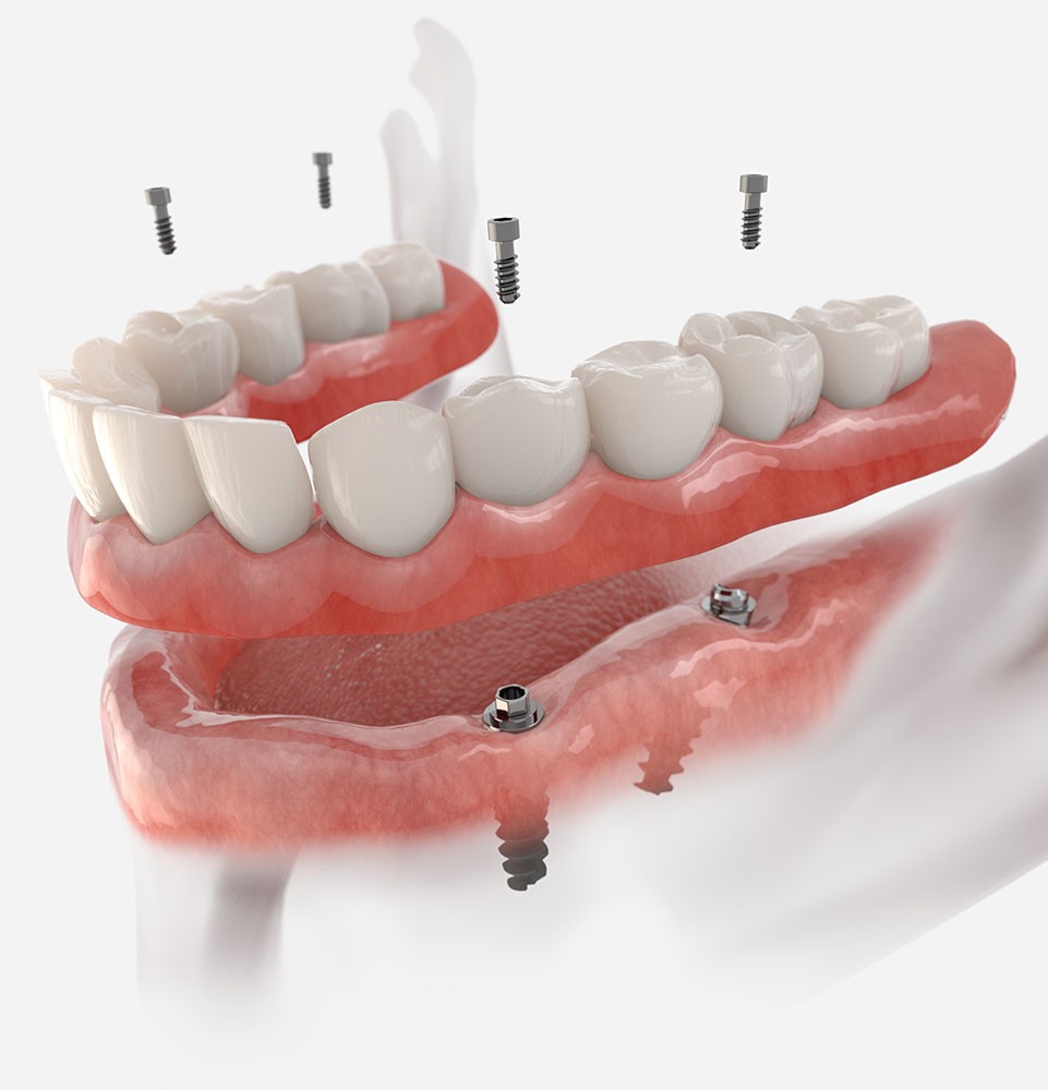 All-on-4 dental implants illustration