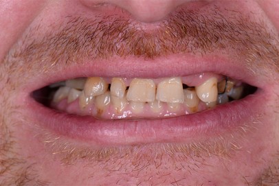 before dental implants