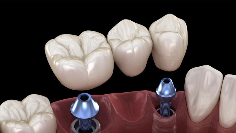 dental implants