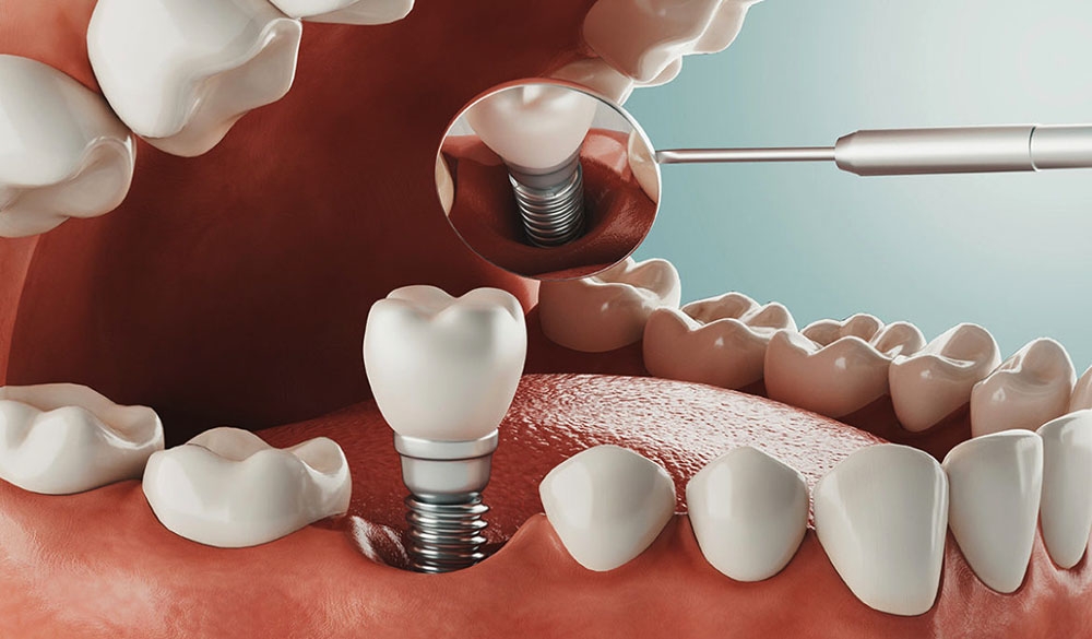 side view of tooth implant