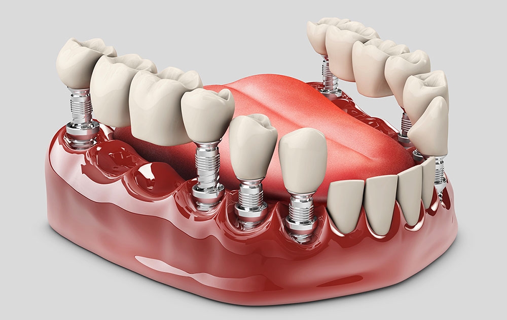 teeth being inserted as dentures