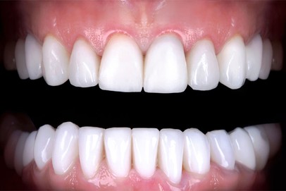 after porcelain veneers