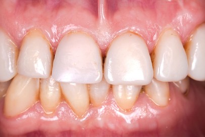 before teeth whitening