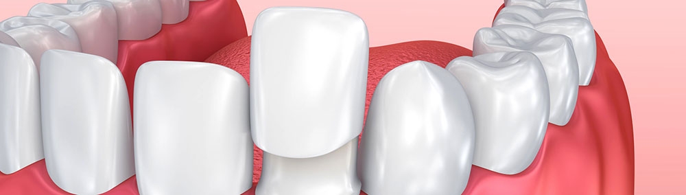 3d tooth model