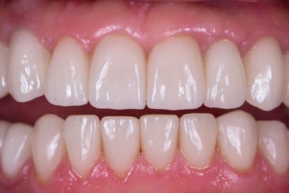 after dental implants