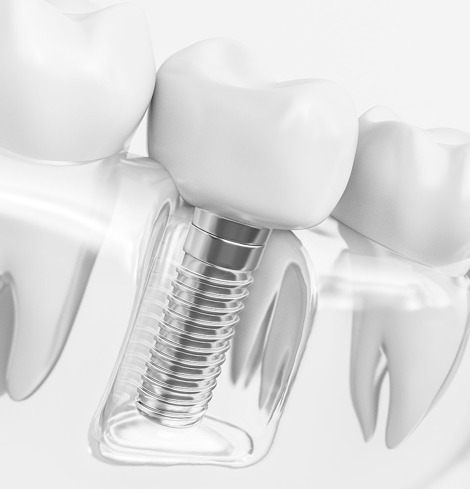 Dental implant illustration