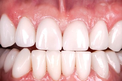 after teeth whitening